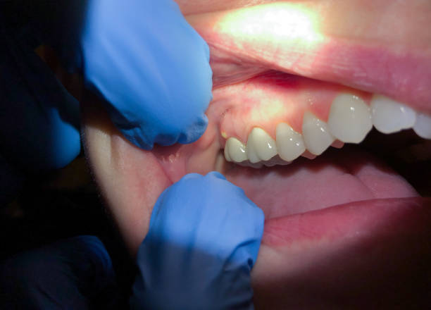 Best Emergency Root Canal Treatment in Powderly, TX